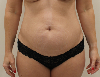 Tummy Tuck before and after - before