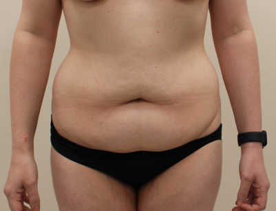 Tummy Tuck before and after - before