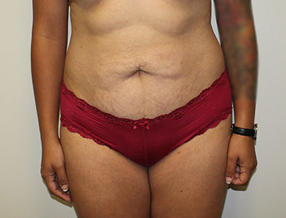 Tummy Tuck before and after - before