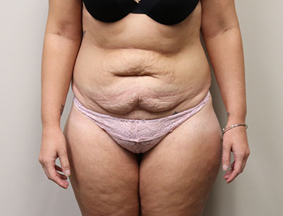 Tummy Tuck before and after - before