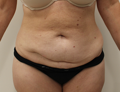Tummy Tuck before and after - before