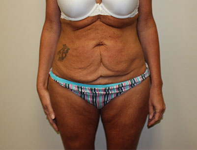 Tummy Tuck before and after - before