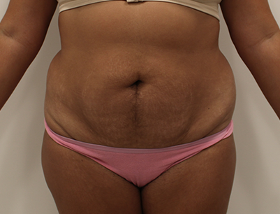 Tummy Tuck before and after - before