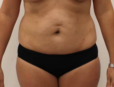 Tummy Tuck before and after - before