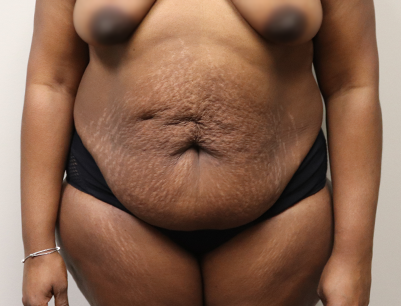 Tummy Tuck before and after - before