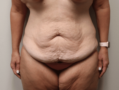 Tummy Tuck before and after - before