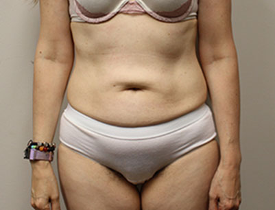 Tummy Tuck before and after - before