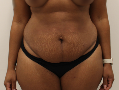 Tummy Tuck before and after - before