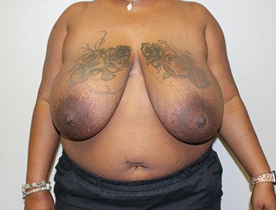 Breast Reduction before and after - before