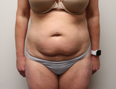 Tummy Tuck before and after - before