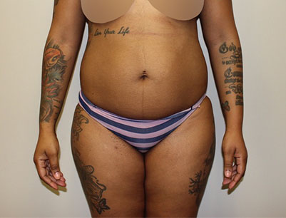 Tummy Tuck before and after - before