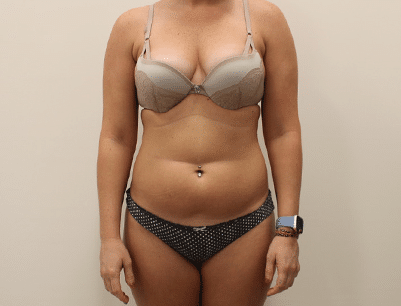 Liposuction before and after - before
