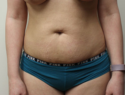 Tummy Tuck before and after - before