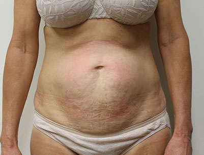 Tummy Tuck before and after - before