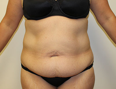 Tummy Tuck before and after - before
