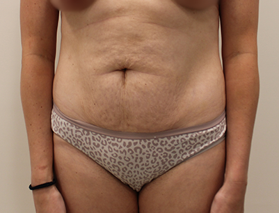Tummy Tuck before and after - before