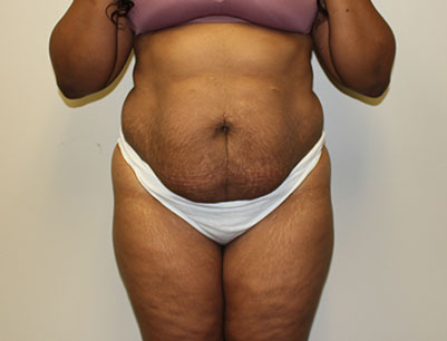 Tummy Tuck before and after - before