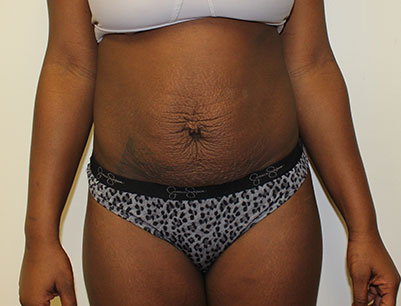 Tummy Tuck before and after - before