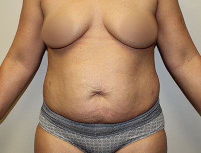 Tummy Tuck before and after - before