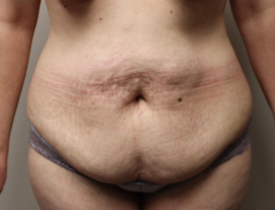 Tummy Tuck before and after - before