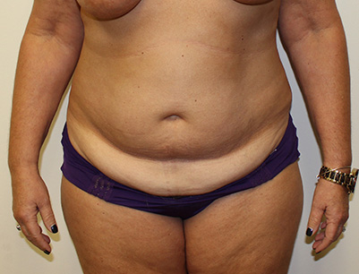 Tummy Tuck before and after - before