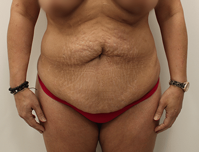 Tummy Tuck before and after - before