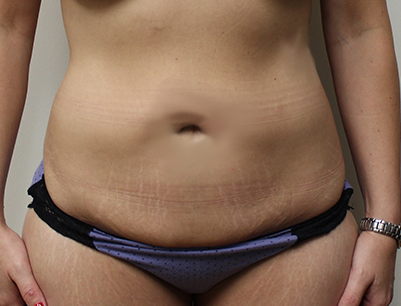 Tummy Tuck before and after - before