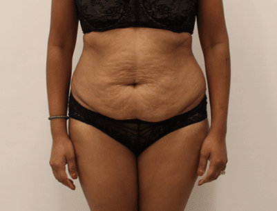 Tummy Tuck before and after - before