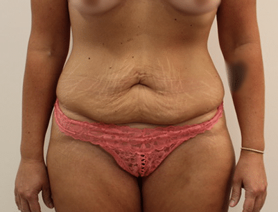Tummy Tuck before and after - before