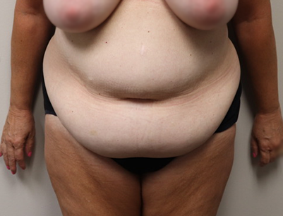 Tummy Tuck before and after - before