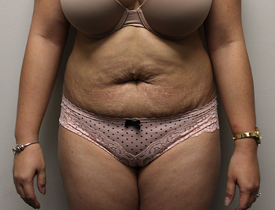 Tummy Tuck before and after - before
