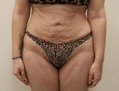 Tummy Tuck before and after - before
