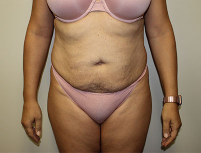 Tummy Tuck before and after - before
