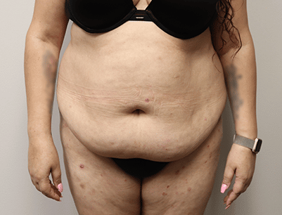 Tummy Tuck before and after - before