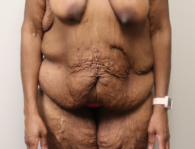 Tummy Tuck before and after - before