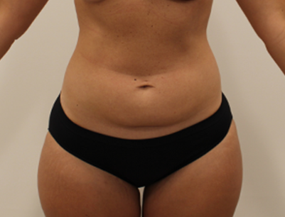 Tummy Tuck before and after - before