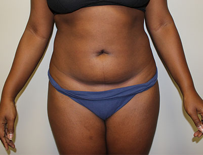 Liposuction before and after - before