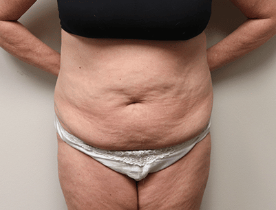 Tummy Tuck before and after - before