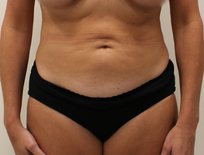 Tummy Tuck before and after - before