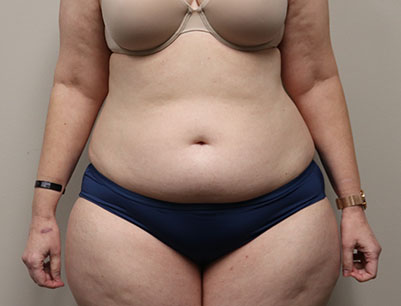 Tummy Tuck before and after - before