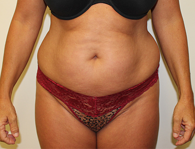 Tummy Tuck before and after - before