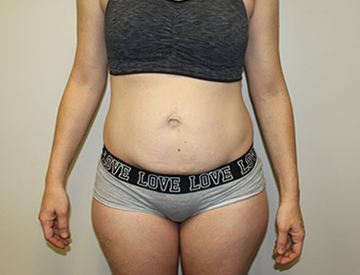 Tummy Tuck before and after - before