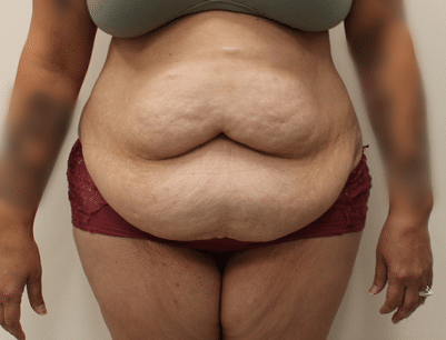 Tummy Tuck before and after - before