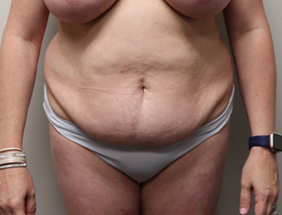 Tummy Tuck before and after - before