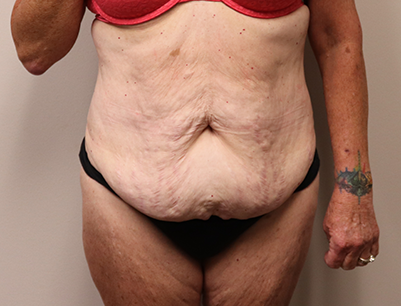 Tummy Tuck before and after - before