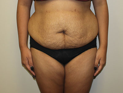 Tummy Tuck before and after - before
