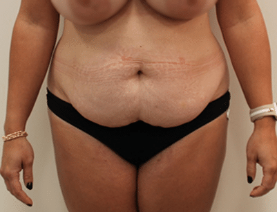 Tummy Tuck before and after - before