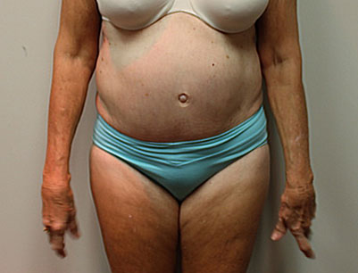 Tummy Tuck before and after - before