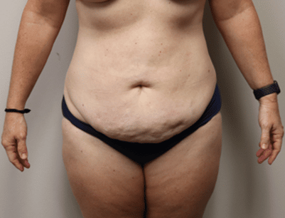 Tummy Tuck before and after - before