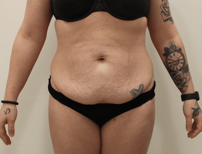 Tummy Tuck before and after - before